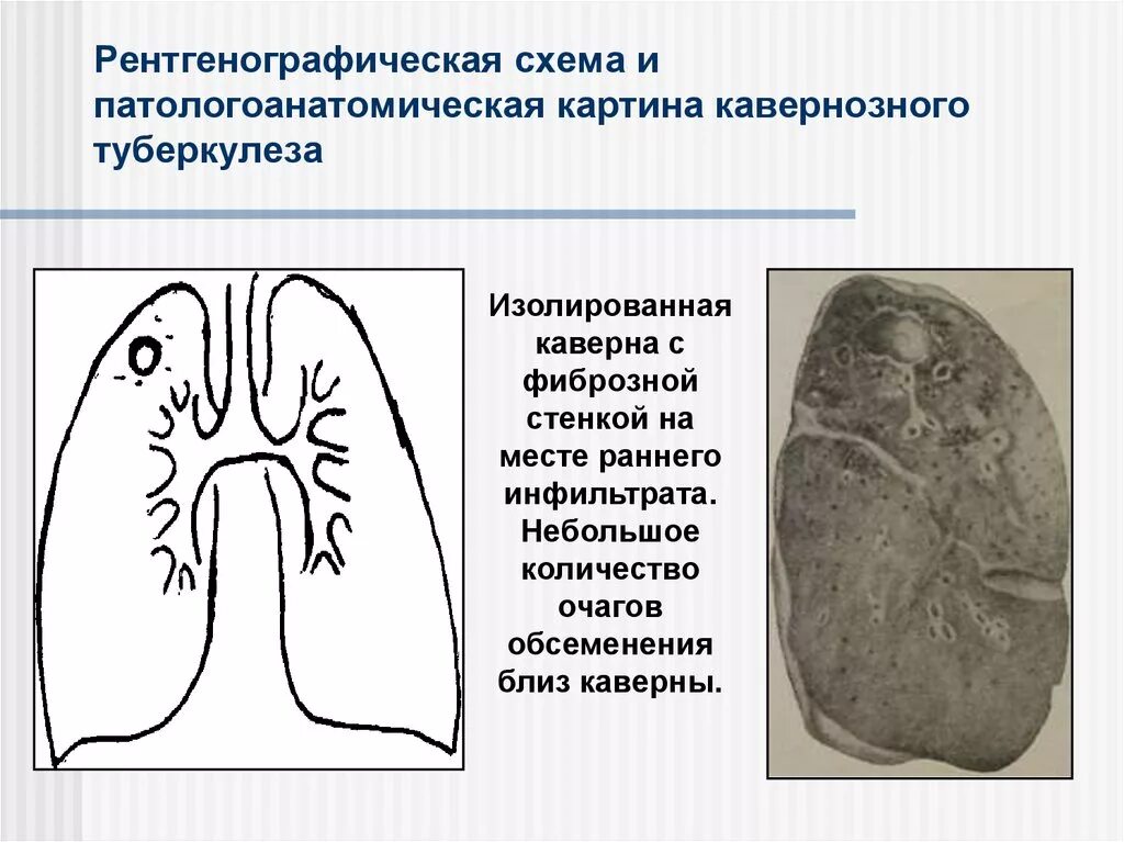 Фиброзно кавернозный туберкулез схема. Кавернозно Цирротический туберкулез. Кавернозный туберкулез фтизиатрия. Фиброзно-кавернозный туберкулез легких клиника.