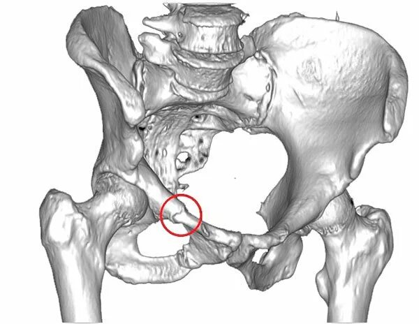 Перелом подвздошной кости симптомы. Краевые переломы костей таза. Краевый перелом кости таза.