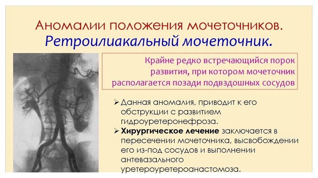 Аномалия статьи. Аномалия развития мочеточников классификация. Аномалии положения мочеточников. Ретроилиакальный мочеточник. Врожденные аномалии мочеточников.