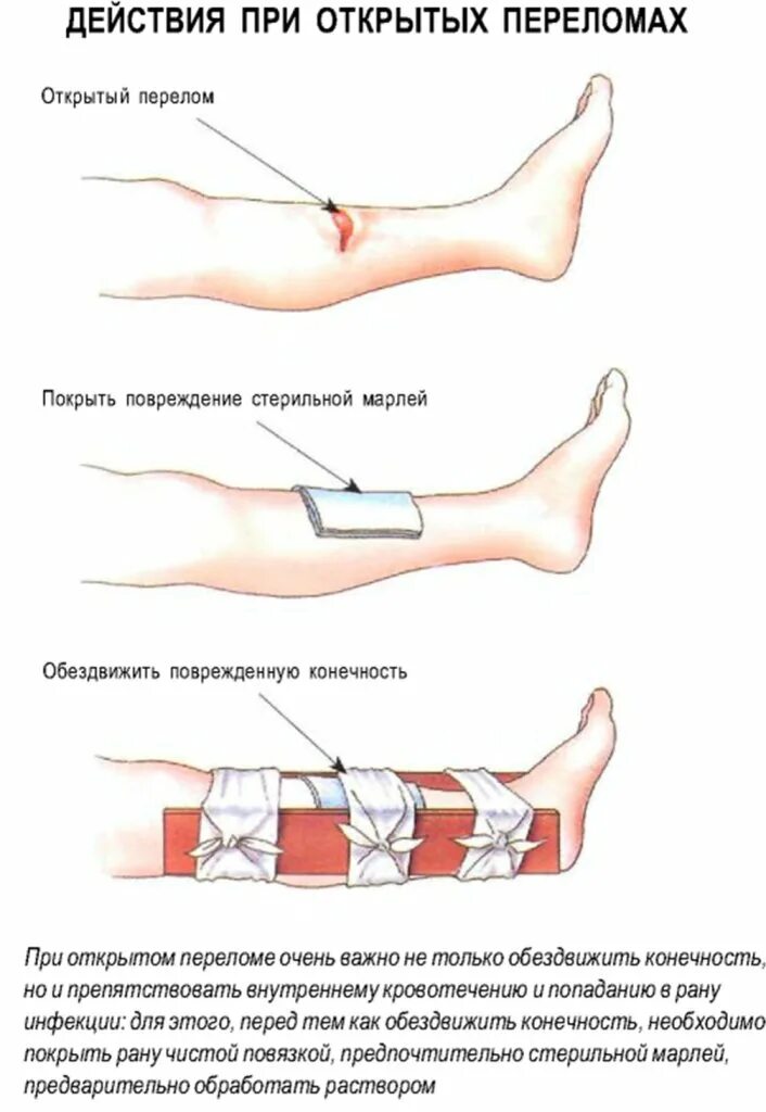 Алгоритм при открытом переломе. Открытый перелом алгоритм действий. Помощь при открытом переломе. Действия при открытом переломе. Алгоритм действий при открытом переломе.