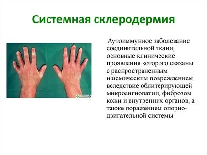 Склероз кожи