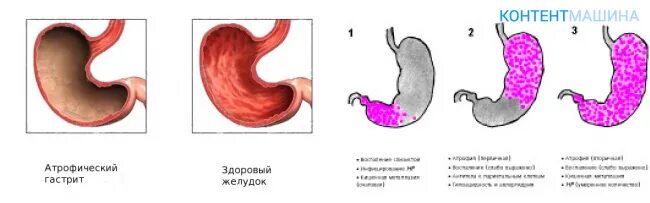 Атрофия слизистой антрального отдела желудка Тип с-1. Антральный и фундальный гастрит. Хронический атрофический гастрит слабой активности. Атрофический антральный гастрит.