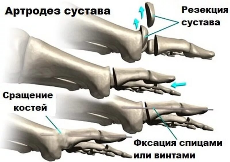 Операция артродез голеностопного сустава. Подтаранный артродез стопы. Суставной панариций артродез. Артропластика 1 плюснефалангового сустава. Артродез суставов операция