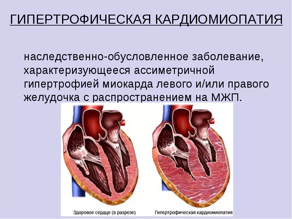 Гипертрофия полостей сердца. Гипертрофия асимметричная кардиомиопатия. дилатационная и гипертрофическая кардиомиопатия. верхушечная гипертрофическая кардиомиопатия. гипертрофия левого желудочка и гипертрофическая кардиомиопатия.