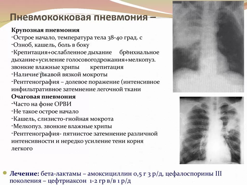 Чем грозит пневмония. Односторонняя пневмония у взрослых симптомы. Симптом острой пневмококковой пневмонии. Воспаление лёгких симптомы у взрослых.