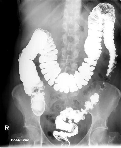 Стеноз кишечника что это. Рентген Толстого кишечника с барием. Ободочная кишка рентген. Сужение сигмовидной кишки рентген. Кишечная непроходимость ирригоскопия.