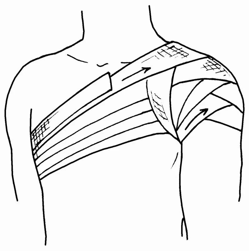Плечевая повязка алгоритм. Колосовидная повязка на плечо. Перевязка колосовидная на плечо. Коллсовидная поаящка на поечо. Колосовильная повязка на плече.