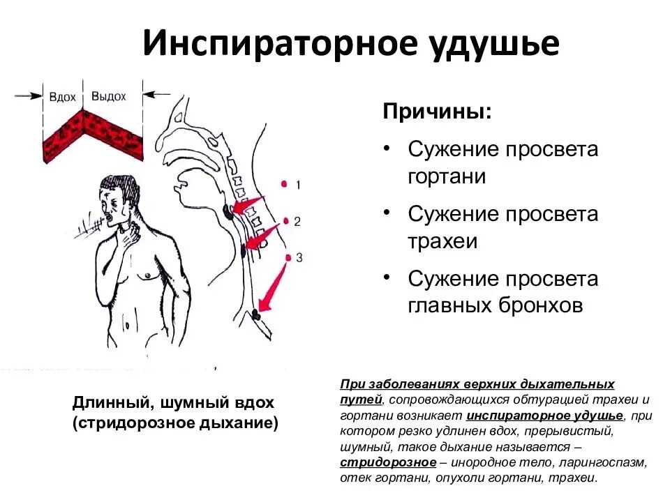 Резко больно дышать. Инспираторное удушье. Инспираторная одышка. Признаки нарушения дыхания при удушении. Причины удушья.