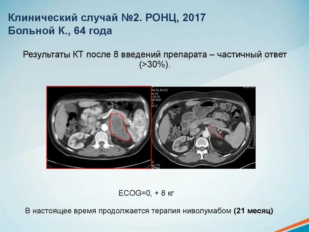 Кт после химиотерапии. Клинический случай. Клинические случаи в терапии. Псевдопрогрессия опухоли. Клинический случай презентация.