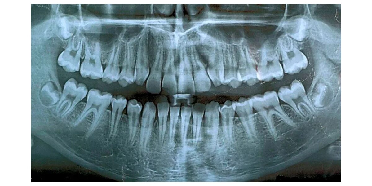 Сколько стоит рентген зуба
