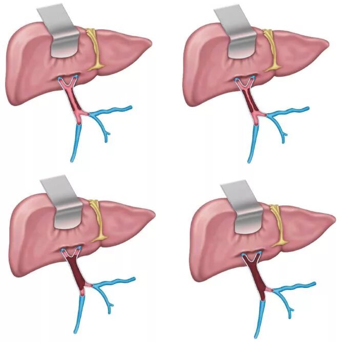Цирроз печени воротная Вена клиника. Тромбэктомия воротной вены. Тромбоз воротной вены на УЗИ. Тромбоз воротной вены печени. Тромбоза вен печени