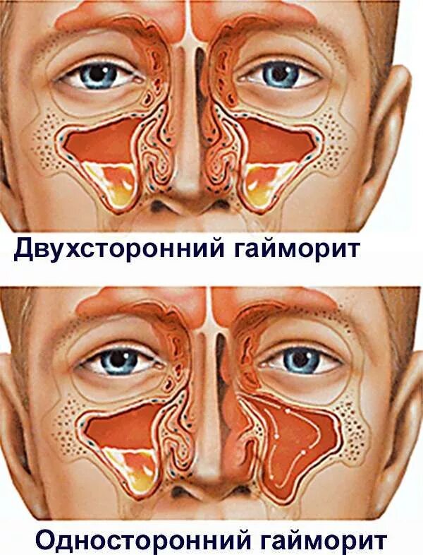 Насморк при гайморите у взрослых