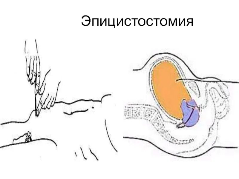 Промывают мочевой пузырь у мужчин. Цистостома мочевого пузыря катетер. Троакарная пункция мочевого пузыря. Цистостомия (эпицистостомия). Троакарная эпицистостома.