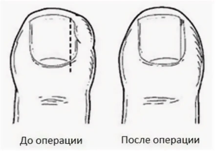 Как подстригать ноготь большого пальца ноги. Краевая резекция вросшего ногтя. Операции на вросший ноготь хирургия. Краевая резекция вросшего ногтя лазером.