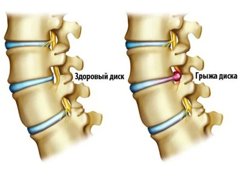 остеохондрозvt;gjpdjyjxyfz gjzcybxyfz uhs;f. грыжа остеохондроз пояснично крестцового отдела позвоночника. протрузия l1-l4. лечение грыжи крестцового отдела позвоночника. грыжа позвоночника поясничного отдела симптомы.