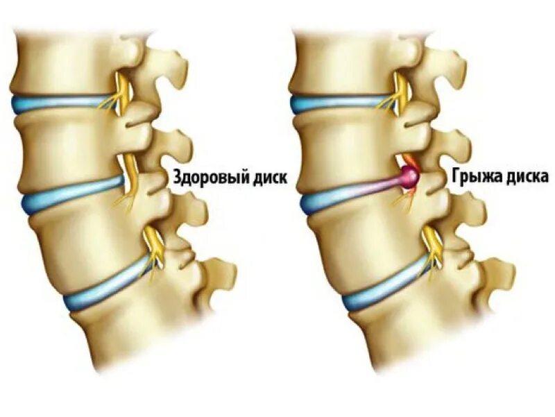 Грыжа позвоночника что это такое