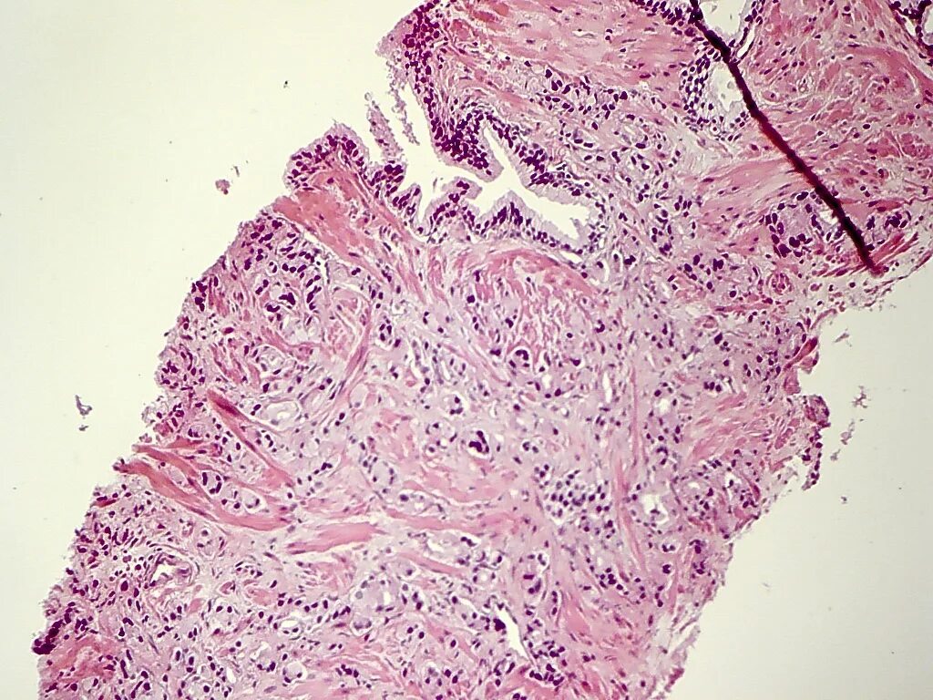 Гистоморфологическое исследование это. Гистология биоптата. Гистологическое исследование биоптата. Злокачественная параганглиома гистология. Гистология биоптата.