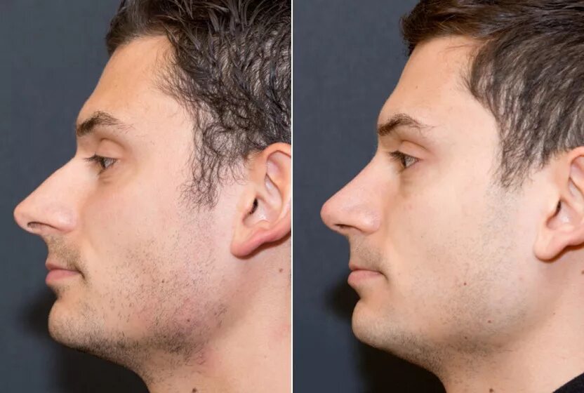 Прямой нос с горбинкой у мужчин. Ринопластика до и после. Мужская ринопластика носа. Нос с небольшой горбинкой у мужчин.