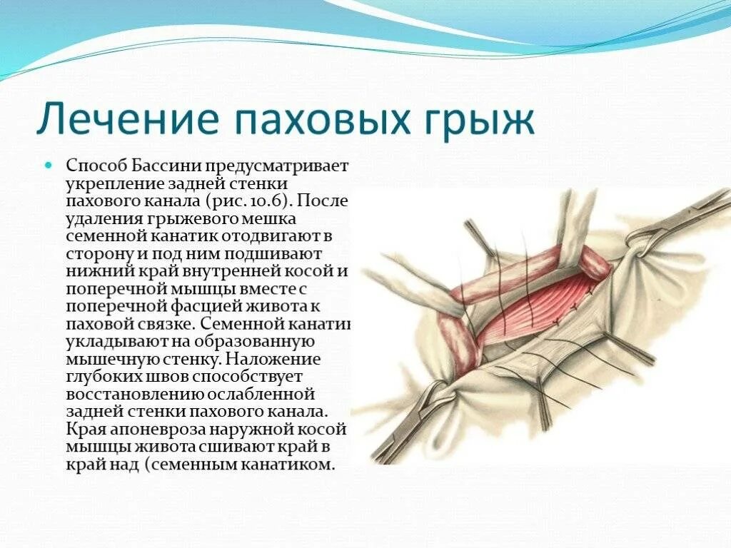 Паховая грыжа методы лечения. Паховая грыжа методика операции. Операции на двухсторонней паховой грыже. Методика вправление паховой грыжи. Классификация операций паховых грыж.