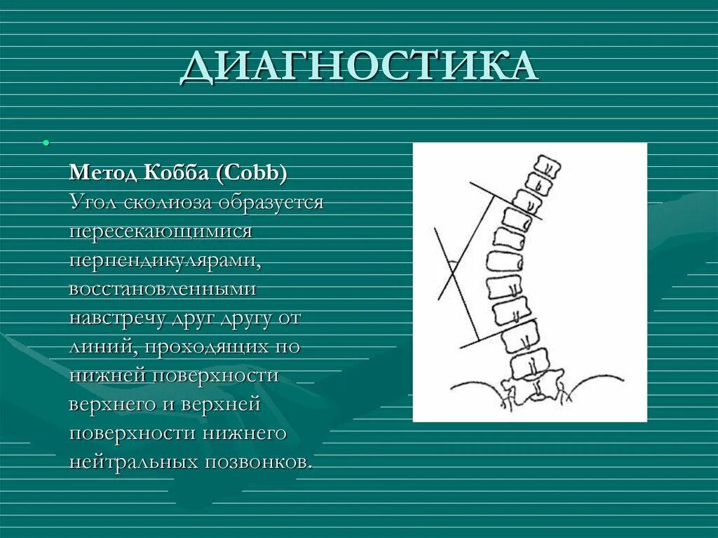 Измерение угла сколиоза по чаклину. Сколиоз по методу Кобба. Метод Кобба сколиоз позвоночника. Угол Кобба степени сколиоза. Угол кобба