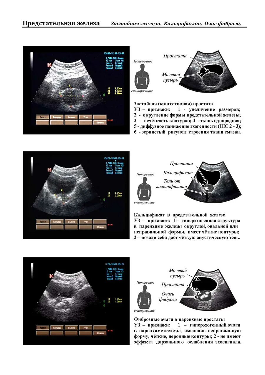УЗИ предстательной железы трансабдоминально. Аллахвердов атлас УЗИ. УЗИ предстательной железы норма. Норма показателей УЗИ предстательной железы. Показатели предстательной железы