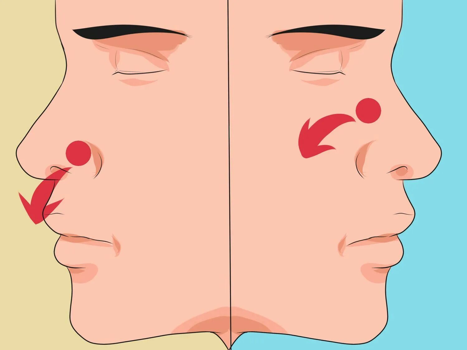 Сильное течение из носа. Переднее и заднее носовое кровотечение.