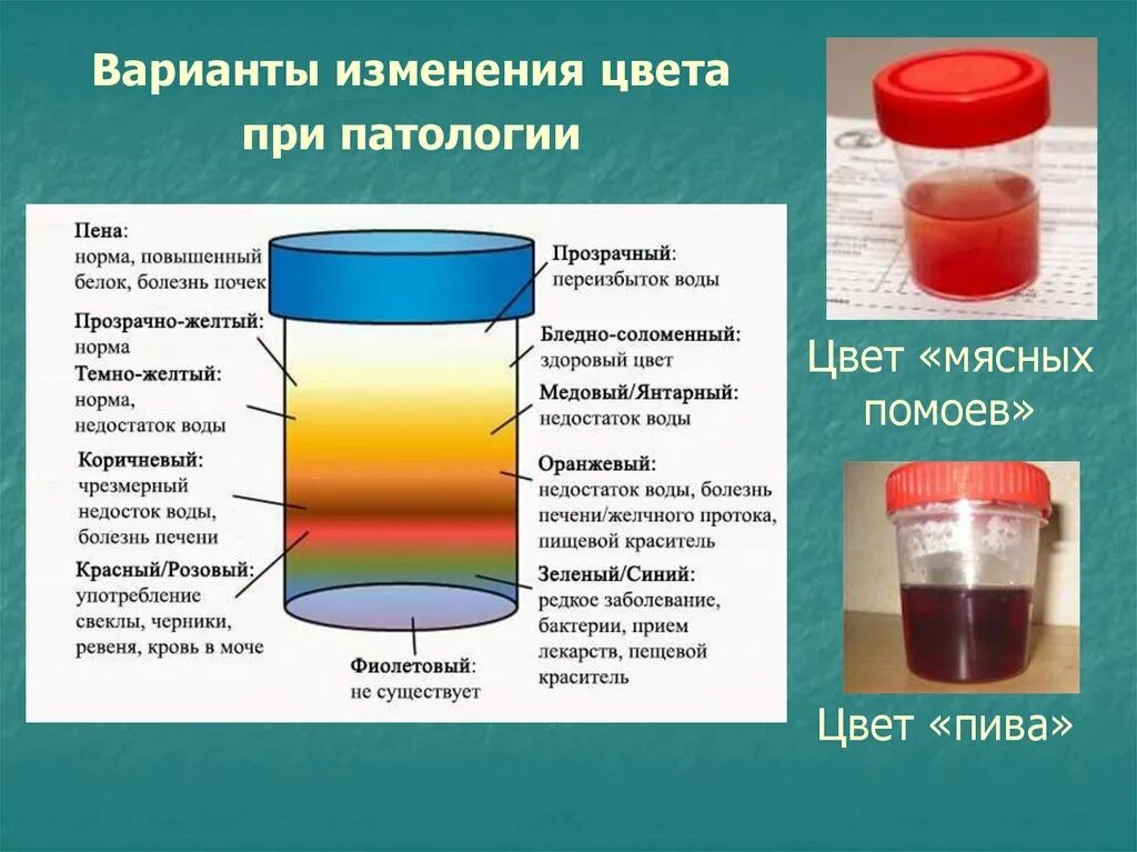 Болезни мочу мужчин. Цвет мочи. Изменение цвета мочи. Изменение цвета мочи причины.