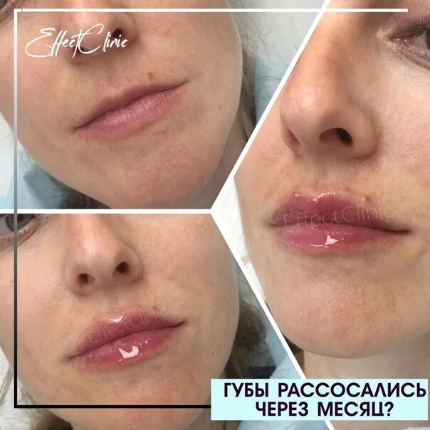 Солярий после увеличения губ через сколько. 1мл филлера в нубах зажившие. зажившие губы после увеличения 1 мл. заживление губ после увеличения.