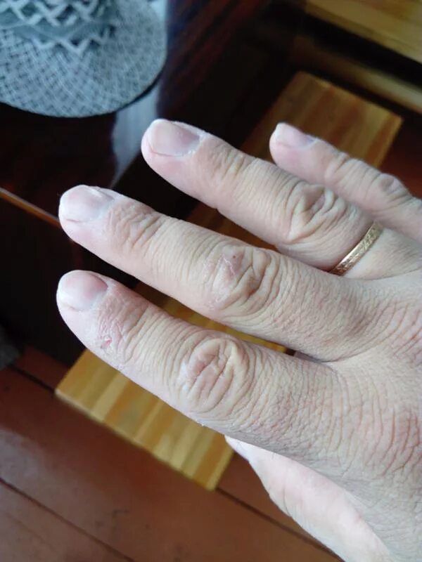 Eczema: Who is Affected and What You Need to Know Sanova Dermatology