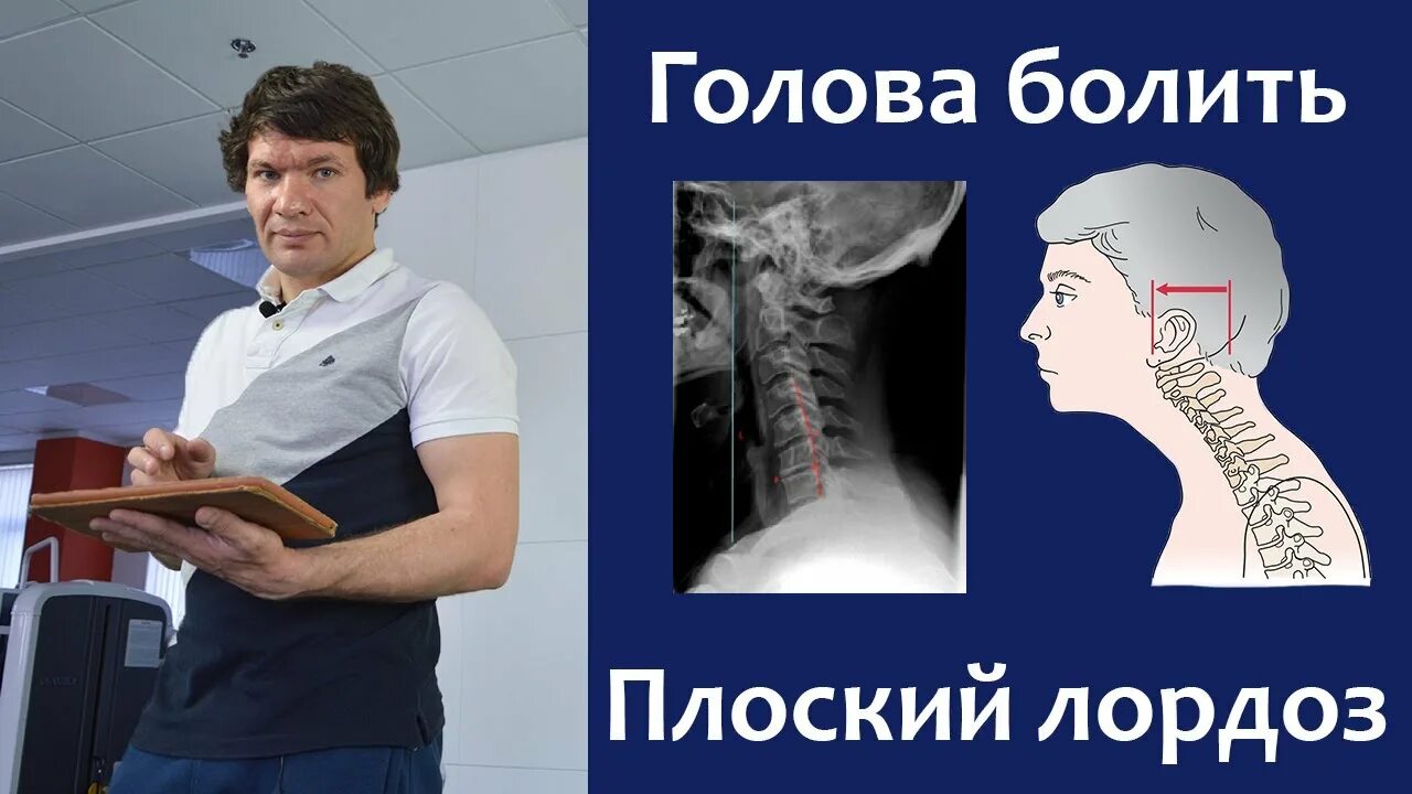 Нарушение статики выпрямление лордоза