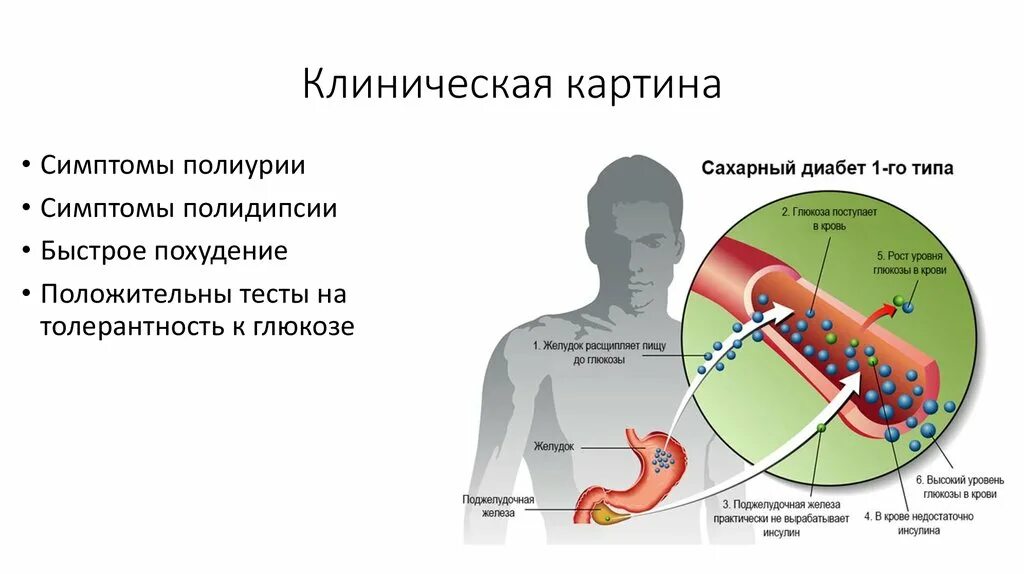 Клинические проявления сахарного диабета 1 типа. Клиническая картина диабета 1 типа. Клиническая картина диабета 2 типа. Клинические симптомы сахарного диабета 2 типа.