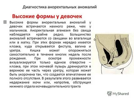 Аноректальные пороки у детей