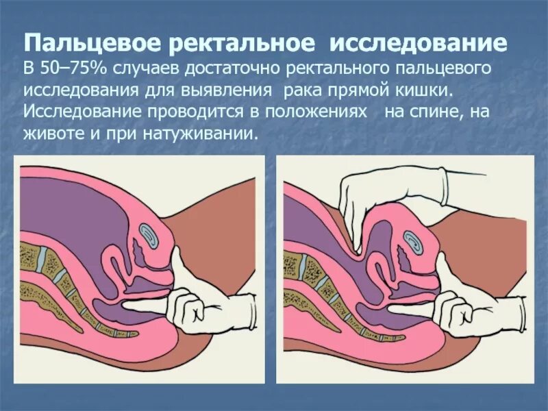 Ректальный рак. Пальцевое ректальное исследование. Палцевое исследованиепрямой кишки. Пальцевое исследование прямой кишки. Ректальное исследование пальцем.