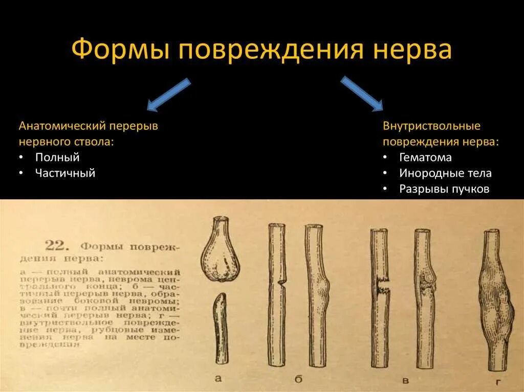 Классификация травматических повреждений периферических нервов.. Механизмы повреждения периферических нервов. Повреждение нервных стволов. Формы повреждения нерва.