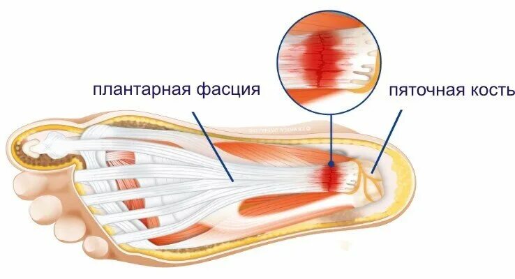 Плантарный фасциит стопы. Что такое плантарный фасцит стопы. Плантарный фасциит мкб. Фасцит в пятке