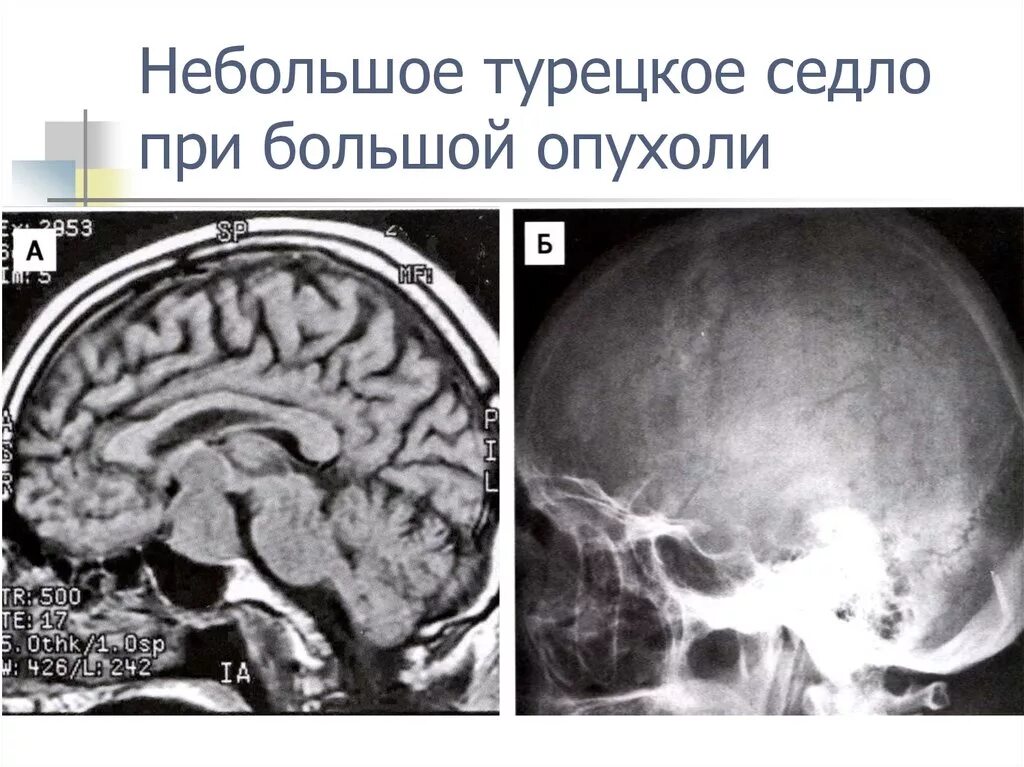 Симптом турецкого седла. Рентген турецкого седла опухоль гипофиза. Гипофиз в турецком седле. Дно турецкого седла анатомия. Турецкое седло расположено.