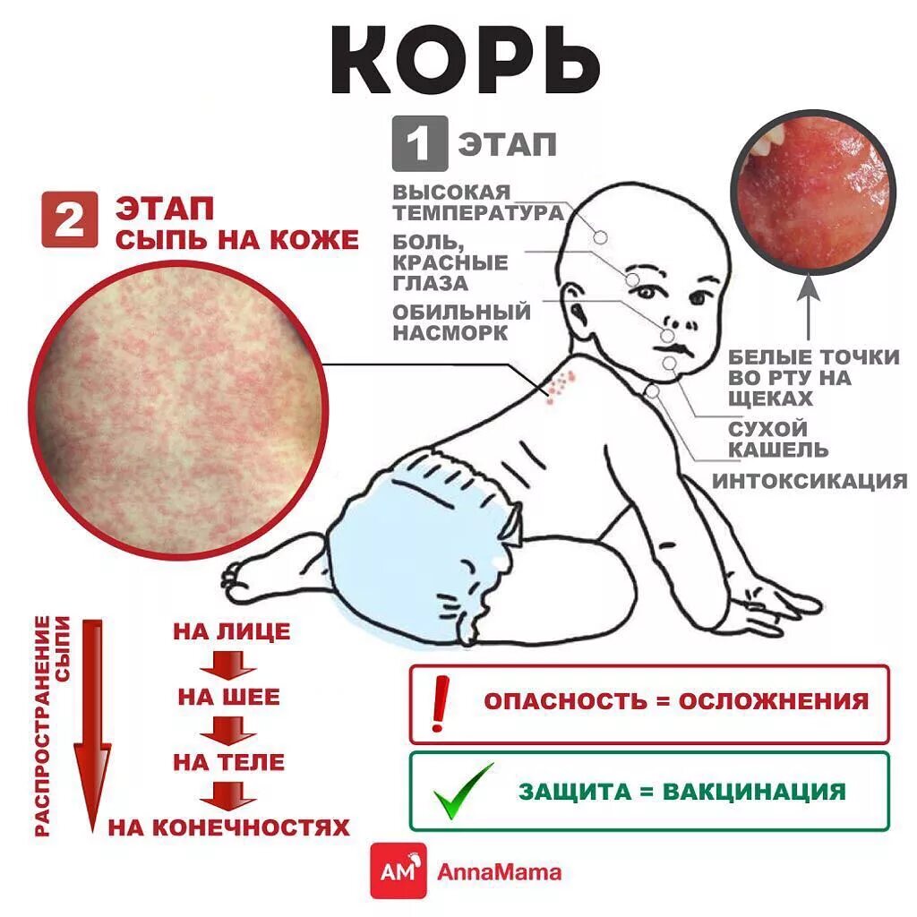 Температура от прививки от кори у ребенка