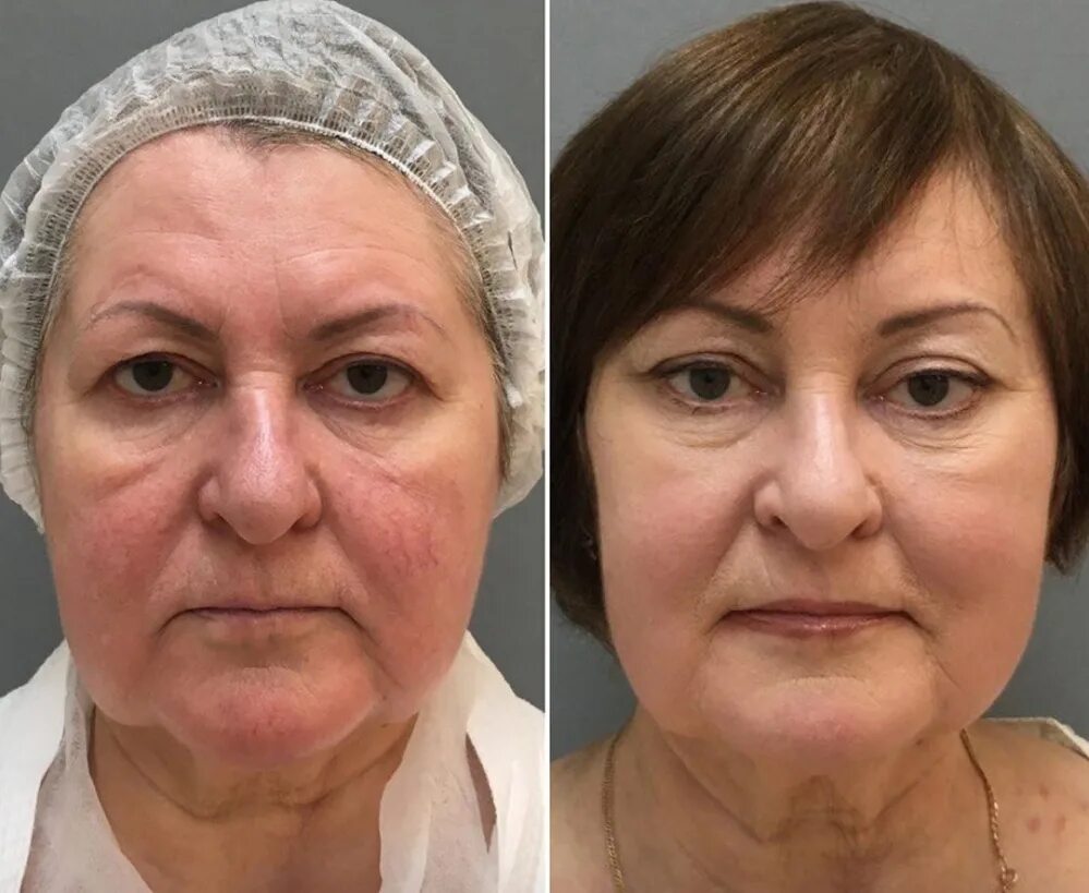 Круговая подтяжка смас лифтинг. Смас подтяжка лица. Безоперационный лифтинг ultherapy. Подтяжка лица отрицательные отзывы. Круговая пластика лица.