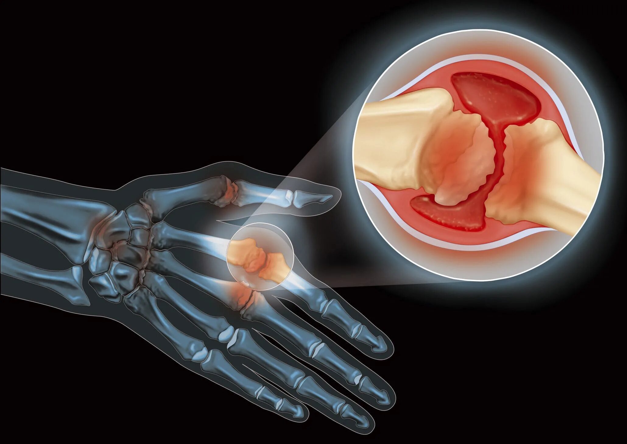 Ревматическое поражение суставов. Ревматоидный артрит суставы. Подагра ревматоидный артрит остеоартрит. Болезнь суставов артрит.