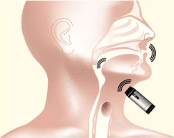 аппараты после удаления гортани. аппараты после удаления гортани. трахеопищеводный шунт. Electrolarynx. аппараты после удаления гортани.