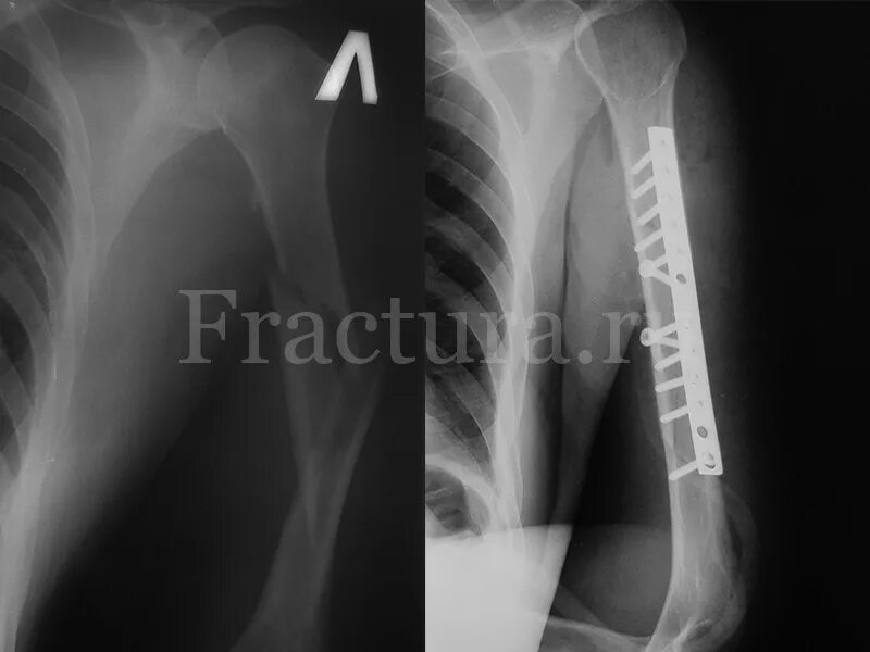 Мос плечевой кости. Перелом хирургической шейки плечевой кости остеосинтез. Остеосинтез пластиной перелома хирургической шейки плечевой кости. Мос плечевой кости. Перелом диафиза плечевой кости рентген.