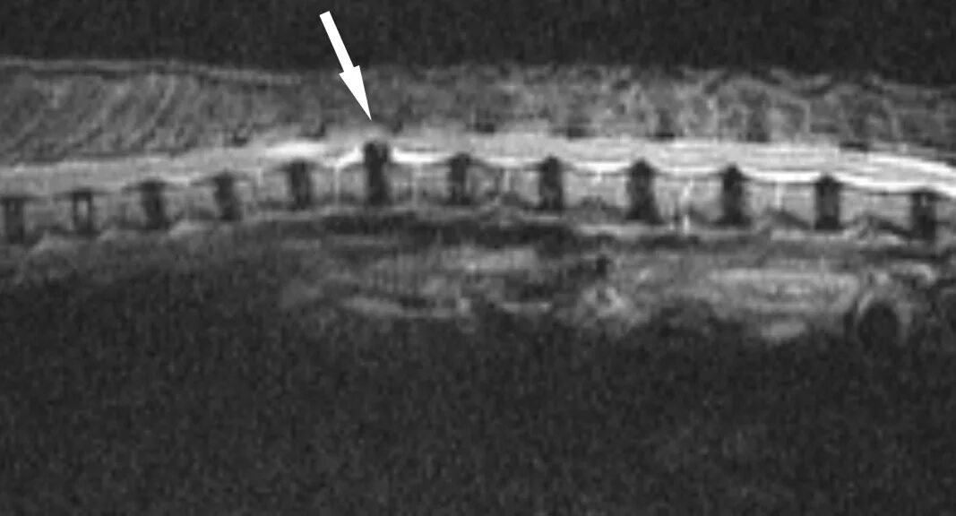Протрузия дисков позвоночника у собак. Грыжа шейного отдела позвоночника у собаки. Экструзия межпозвонкового диска у собак. Дископатия шейного отдела. Экструзия межпозвоночного диска у собак.