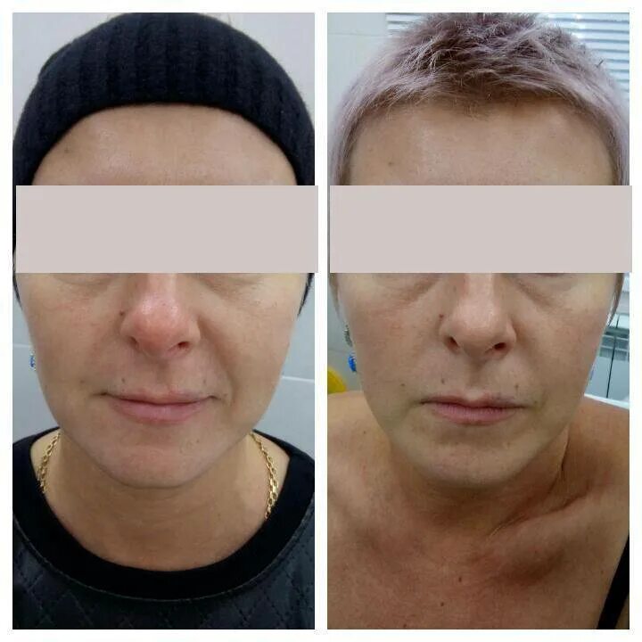 Плазмолифтинг в косметологии. Плазмолифтинг визитка. Методика проведения плазмолифтинга лица. Плазмолифтинг листовка. Плазмолифтинг для лица протокол.