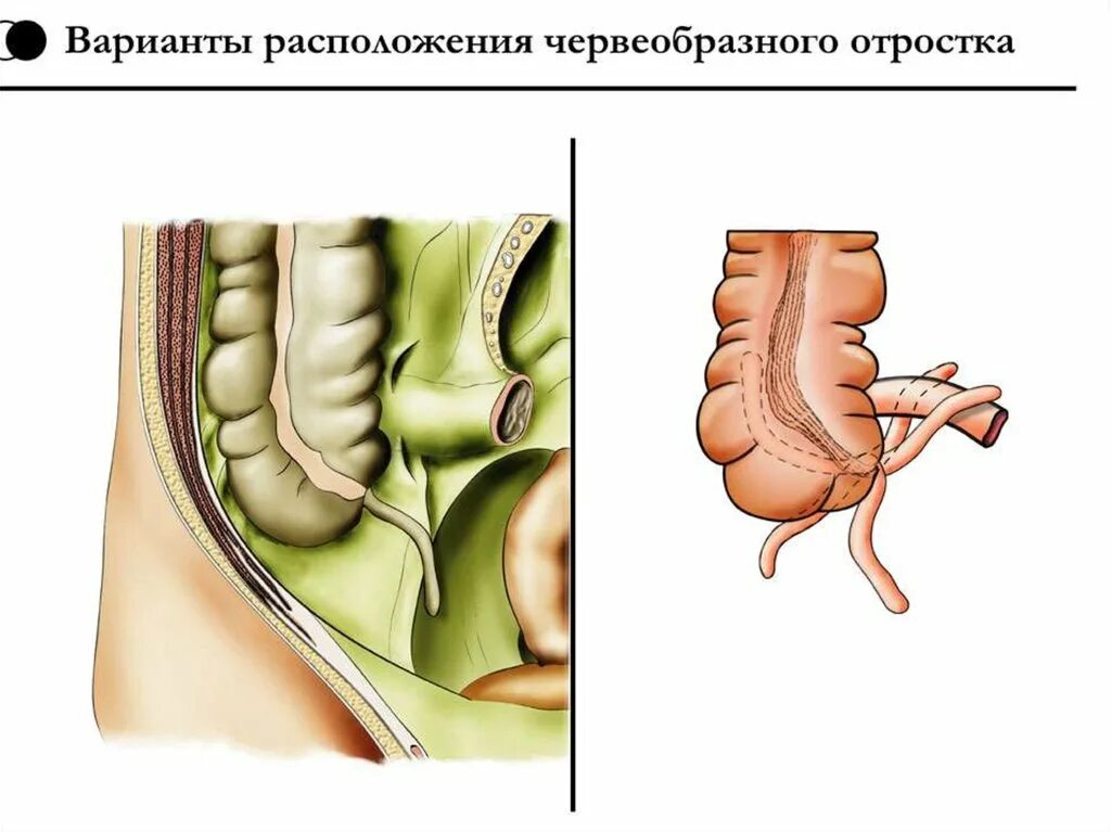 Аппендикс червеобразный. Топография червеобразного отростка. Расположение червеобразного отростка. Ретроперитонеальное расположение червеобразного отростка.