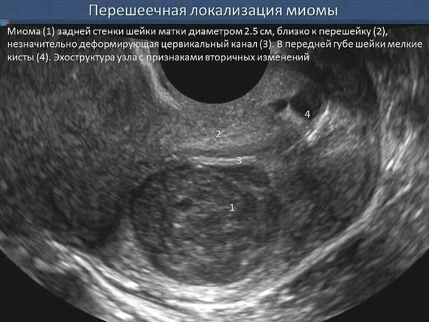 Полость матки деформирована. Шеечная локализация миомы. Шеечный миоматозный узел.