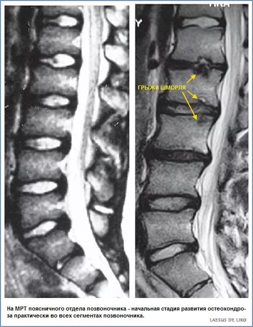 Грыжа Шморля замыкательная пластинка. Остеохондроз поясничного отдела мрт. Спондилит поясничного отдела позвоночника мрт. Дегенеративные изменения позвоночника мрт.