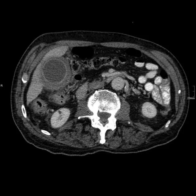 Острый калькулезный холецистит на кт. Гангренозный холецистит кт. Хронический калькулезный холецистит на кт. Камни в желчном кт