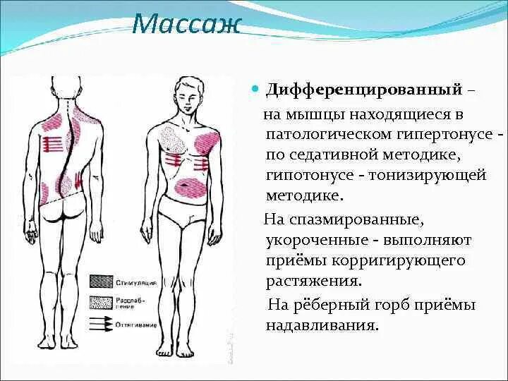 Мышца в гипертонусе. Гипертонус мышц при сколиозе. Массаж при сколиозе. Мышечный гипертонус в конечностях. Тонус поясницы