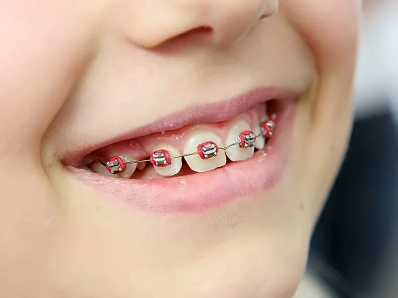 сколько стоят брекеты в йошкар оле. металлические лигатурные брекеты alexander. брекет система мини даймонд. металлические брекеты мини даймонд лигатурные. керамические брекеты и металлические разница.