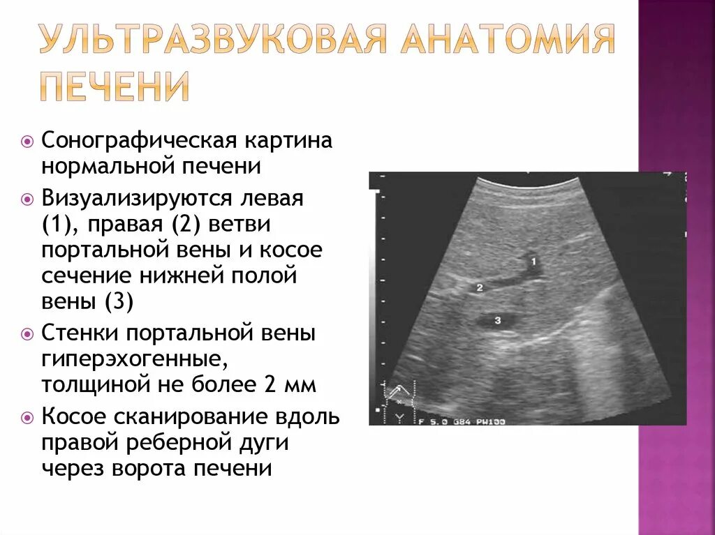 Ультразвуковая анатомия печени сегменты. Ультразвуковая анатомия ворот печени. Сегменты печени на УЗИ. Нормальная анатомия печени УЗИ. Узи печени схема